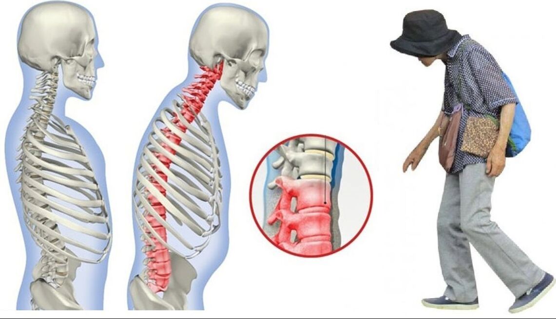 Back pain due to Bechterew's disease