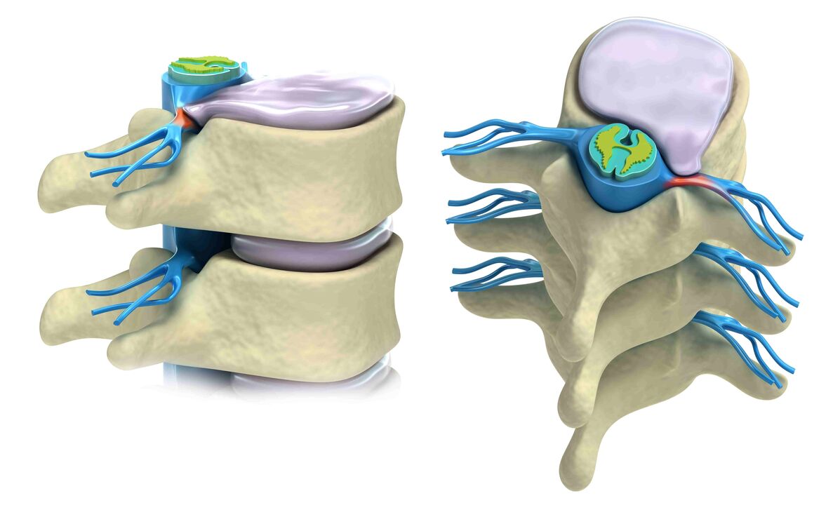damaged intervertebral disc
