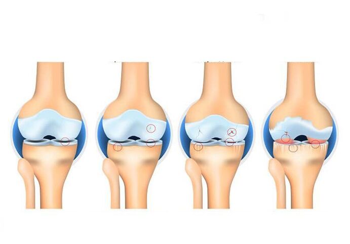 stages of osteoarthritis