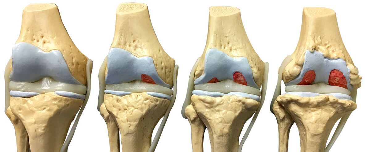 Arthrosis stadium of the knee joint