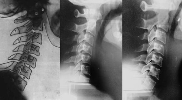 Neck with a shift of the first cervical vertebrae