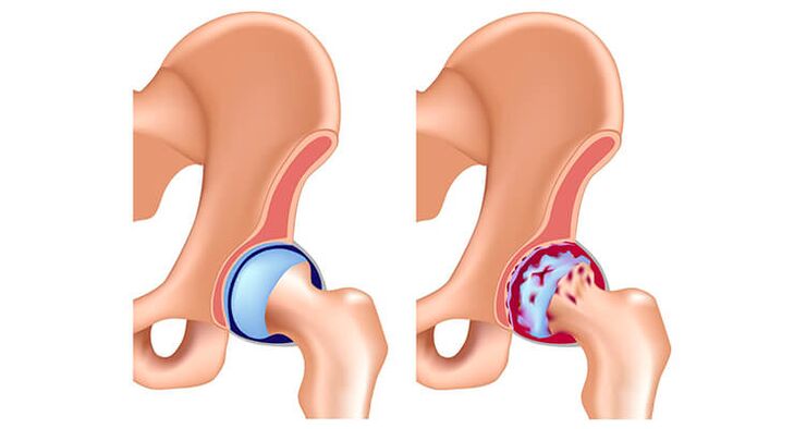 Arthrosis of the hip joint
